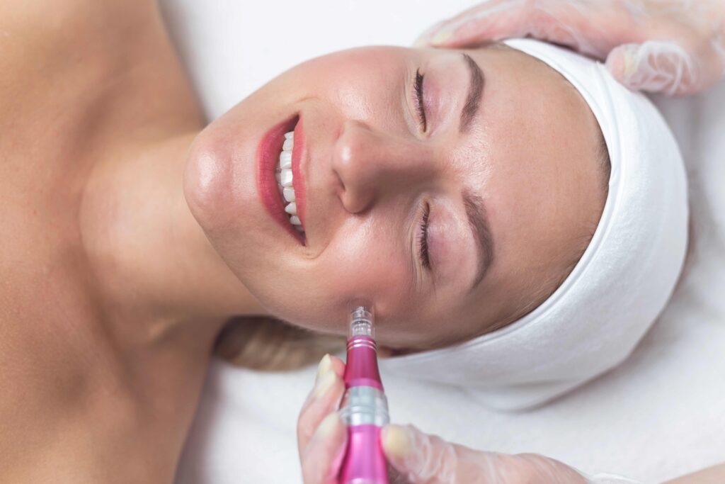 Microneedling